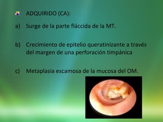 ADQUIRIDO (CA):
a) Surge de la parte fláccida de la MT.
b) Crecimiento de epitelio queratinizante a través
del margen de una perforación timpánica
c) Metaplasia escamosa de la mucosa del OM.
 