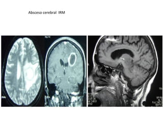 Absceso cerebral IRM
 
