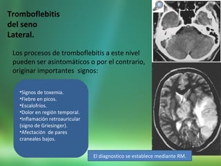 Tromboflebitis
del seno
Lateral.
Los procesos de tromboflebitis a este nivel
pueden ser asintomáticos o por el contrario,
originar importantes signos:
•Signos de toxemia.
•Fiebre en picos.
•Escalofríos.
•Dolor en región temporal.
•Inflamación retroauricular
(signo de Griesinger).
•Afectación de pares
craneales bajos.
El diagnostico se establece mediante RM.
 