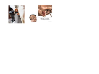 Otitis media cronica