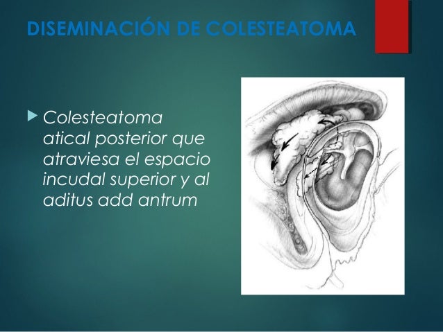 OTITIS MEDIA CRONICA COLESTEATOMA
