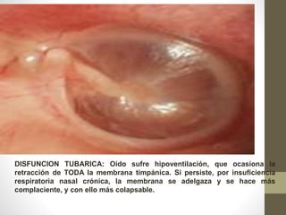 DISFUNCION TUBARICA: Oído sufre hipoventilación, que ocasiona la 
retracción de TODA la membrana timpánica. Si persiste, por insuficiencia 
respiratoria nasal crónica, la membrana se adelgaza y se hace más 
complaciente, y con ello más colapsable. 
 
