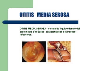 OTITIS MEDIA SEROSA : contenido liquido dentro del
oído medio sin datos característicos de proceso
infeccioso.
 