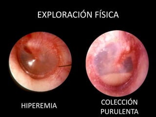 EXPLORACIÓN FÍSICA




HIPEREMIA        COLECCIÓN
                 PURULENTA
 