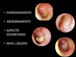 • ENGROSAMIENTO

• ABOMBAMIENTO

• ASPECTO
  ESCARCHADO

• NIVEL LÍQUIDO
 