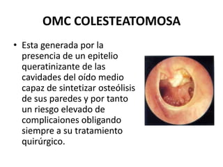 OMC COLESTEATOMOSA
• Esta generada por la
  presencia de un epitelio
  queratinizante de las
  cavidades del oído medio
  capaz de sintetizar osteólisis
  de sus paredes y por tanto
  un riesgo elevado de
  complicaiones obligando
  siempre a su tratamiento
  quirúrgico.
 