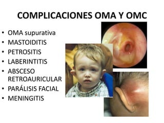 COMPLICACIONES OMA Y OMC
• OMA supurativa
• MASTOIDITIS
• PETROSITIS
• LABERINTITIS
• ABSCESO
  RETROAURICULAR
• PARÁLISIS FACIAL
• MENINGITIS
 