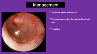Management
Antibiotics against Streptococcus
Decongestants to releve the edema to Euestichian
tube
Painkillers
 