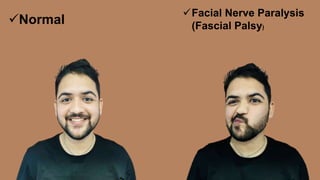 Facial Nerve Paralysis
(Fascial Palsy)
Normal
 