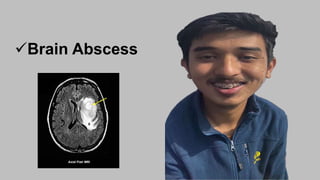 Brain Abscess
 