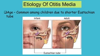 Age – Common among children due to shorter Eustachian
tube
Etiology Of Otitis Media
 