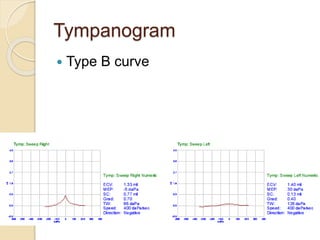 Tympanogram
 Type B curve
 