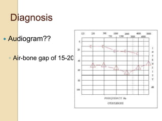 Diagnosis
 Audiogram??
◦ Air-bone gap of 15-20dB
 