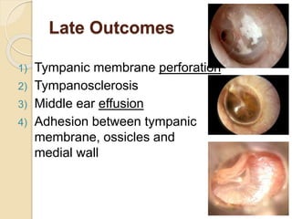 Late Outcomes
1) Tympanic membrane perforation
2) Tympanosclerosis
3) Middle ear effusion
4) Adhesion between tympanic
membrane, ossicles and
medial wall
 