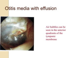 Otitis media with effusion
Air bubbles can be
seen in the anterior
quadrants of the
tympanic
membrane
 