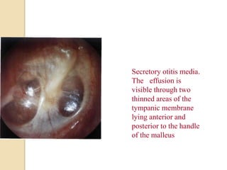 Secretory otitis media.
The effusion is
visible through two
thinned areas of the
tympanic membrane
lying anterior and
posterior to the handle
of the malleus
 