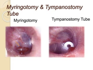 Myringotomy & Tympanostomy
Tube
Myringotomy Tympanostomy Tube
Mercado 2011 ©
Mercado 2011 ©
 