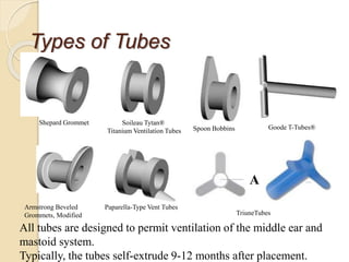 Types of Tubes
Shepard Grommet Soileau Tytan®
Titanium Ventilation Tubes Spoon Bobbins Goode T-Tubes®
Armstrong Beveled
Grommets, Modified
Paparella-Type Vent Tubes
TriuneTubes
A
All tubes are designed to permit ventilation of the middle ear and
mastoid system.
Typically, the tubes self-extrude 9-12 months after placement.
 