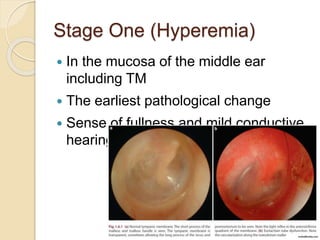 Stage One (Hyperemia)
 In the mucosa of the middle ear
including TM
 The earliest pathological change
 Sense of fullness and mild conductive
hearing loss
 
