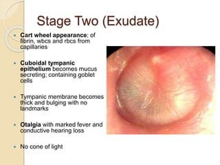 Stage Two (Exudate)
 Cart wheel appearance; of
fibrin, wbcs and rbcs from
capillaries
 Cuboidal tympanic
epithelium becomes mucus
secreting; containing goblet
cells
 Tympanic membrane becomes
thick and bulging with no
landmarks
 Otalgia with marked fever and
conductive hearing loss
 No cone of light
 