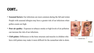 Otitis Media in Children ||PPT|| SlideShare | PPTX