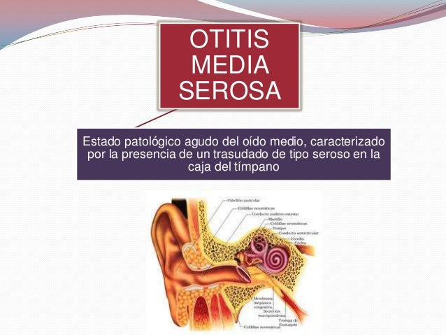 Otitis Media Serosa