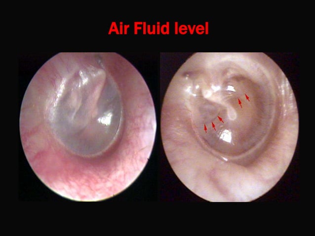 Otitis Media With Effusion PPT Otitis Media With Effusion PPT