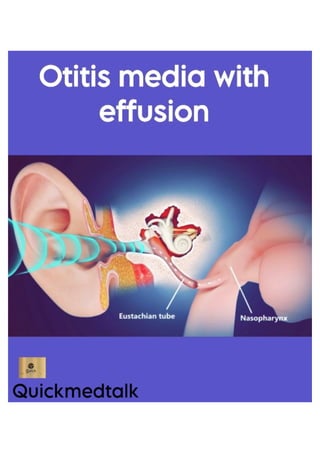 Otitis media with effusion .pdf ENT BY QUICKMEDTALK