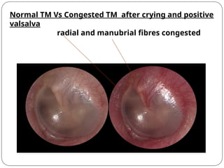 OTITIS MEDIA WITH EFFUSION / SEROUS OTITIS MEDIA.pptx