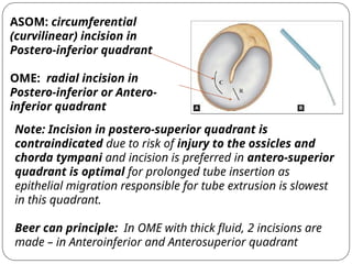 OTITIS MEDIA WITH EFFUSION / SEROUS OTITIS MEDIA.pptx