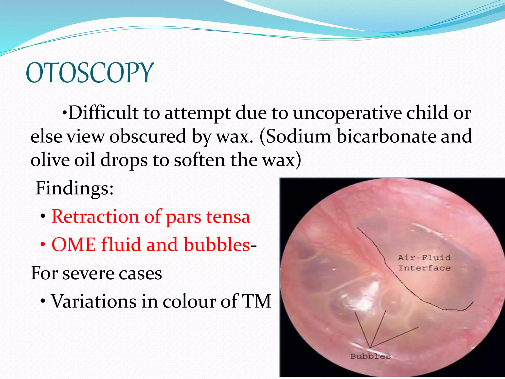Otitis Media With Effusion PPTX Otitis Media With Effusion PPTX