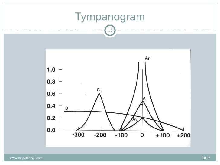 Otitis media with effusion ome