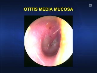 OTITIS MEDIA MUCOSAOTITIS MEDIA MUCOSA
 