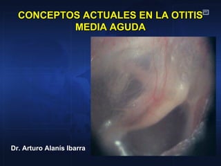 CONCEPTOS ACTUALES EN LA OTITISCONCEPTOS ACTUALES EN LA OTITIS
MEDIA AGUDAMEDIA AGUDA
Dr. Arturo Alanís Ibarra
 