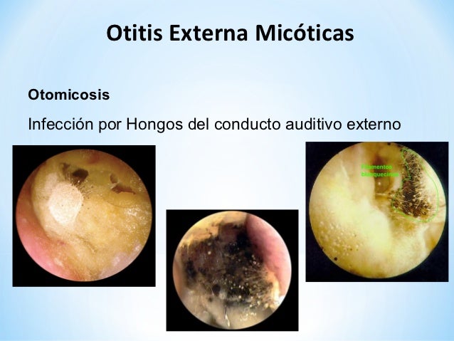 El ungüento del hongo en las manos barata