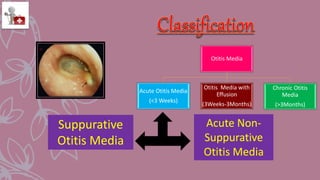 Otitis Media
Acute Otitis Media
(<3 Weeks)
Otitis Media with
Effusion
(3Weeks-3Months)
Chronic Otitis
Media
(>3Months)
Suppurative
Otitis Media
Acute Non-
Suppurative
Otitis Media
 
