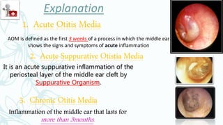 Inflammation of the middle ear that lasts for
more than 3months.
3. Chronic Otitis Media
1. Acute Otitis Media
AOM is defined as the first 3 weeks of a process in which the middle ear
shows the signs and symptoms of acute inflammation
2. Acute Suppurative Otistia Media
It is an acute suppurative inflammation of the
periosteal layer of the middle ear cleft by
Suppurative Organism.
 