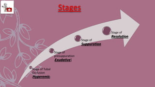 Stages
Stage of Tubal
Occlusion
[Hyperemic]
Stage of
presuppuration
[Exudative]
Stage of
Suppuration
Stage of
Resolution
 