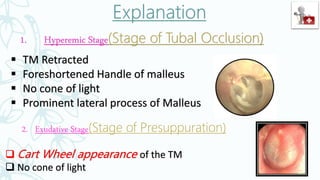 1. Hyperemic Stage(Stage of Tubal Occlusion)
 TM Retracted
 Foreshortened Handle of malleus
 No cone of light
 Prominent lateral process of Malleus
2. Exudative Stage(Stage of Presuppuration)
 Cart Wheel appearance of the TM
 No cone of light
 