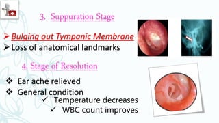 3. Suppuration Stage
Bulging out Tympanic Membrane
Loss of anatomical landmarks
4. Stage of Resolution
 Ear ache relieved
 General condition
 Temperature decreases
 WBC count improves
 
