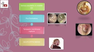 Serous exudates in middle
ear
Pus Formation
Tympanic membrane
rupture
ACUTE OTITIS MEDIA
 