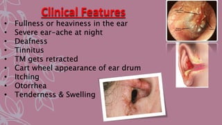 Clinical Features
• Fullness or heaviness in the ear
• Severe ear-ache at night
• Deafness
• Tinnitus
• TM gets retracted
• Cart wheel appearance of ear drum
• Itching
• Otorrhea
• Tenderness & Swelling
 