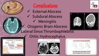 Complications
 External Abscess
 Subdural Abscess
 Meningitis
 Otogenic Brain Abscess
 Lateral SinusThrombophlebitis
 Otitic Hydrocephalus
 