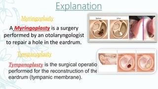 Myringoplasty
A Myringoplasty is a surgery
performed by an otolaryngologist
to repair a hole in the eardrum.
Tympanoplasty
Tympanoplasty is the surgical operation
performed for the reconstruction of the
eardrum (tympanic membrane).
 