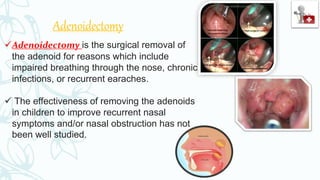 Adenoidectomy
Adenoidectomy is the surgical removal of
the adenoid for reasons which include
impaired breathing through the nose, chronic
infections, or recurrent earaches.
 The effectiveness of removing the adenoids
in children to improve recurrent nasal
symptoms and/or nasal obstruction has not
been well studied.
 