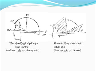 T m v n đ ng kh p khu uầ ậ ộ ớ ỷ T m v n đ ng kh p khu uầ ậ ộ ớ ỷ
bình th ngườ b h n chị ạ ế
(du i 0-10ỗ 0
, g p 150ậ 0
, t m 150-160ầ 0
) (du i -30ỗ 0
, g p 90ậ 0
, t m 60ầ 0
)
 