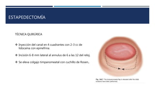 ESTAPEDECTOMÍA
TÉCNICA QUIRÚRICA
 Inyección del canal en 4 cuadrantes con 2-3 cc de
lidocaína con epinefrina.
 Incisión 6-8 mm lateral al annulus de 6 a las 12 del reloj.
 Se eleva colgajo timpanomeatal con cuchillo de Rosen,.
 