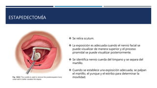 ESTAPEDECTOMÍA
 Se retira scutum.
 La exposición es adecuada cuando el nervio facial se
puede visualizar de manera superior y el proceso
piramidal se puede visualizar posteriormente.
 Se identifica nervio cuerda del timpano y se separa del
martillo.
 Cuando se establece una exposición adecuada, se palpan
el martillo, el yunque y el estribo para determinar la
movilidad.
 
