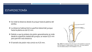 ESTAPEDECTOMÍA
 Se mide la distancia desde el yunque hasta la platina del
estribo.
 La distancia habitual de la superficie lateral del yunque
hasta la platina es de 4,5 mm.
 Debido a que la prótesis de pistón generalmente se mide
desde la superficie medial del yunque, se restan 0,25 mm
para permitir esta distancia.
 El tamaño de pistón más común es 4.25 mm.
 