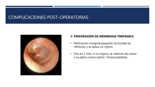 COMPLICACIONES POST-OPERATORIAS
 PERFORACIÓN DE MEMBRANA TIMPÁNICA
• Perforación marginal pequeña: los bordes se
refrescan y se aplica un injerto.
• Cita en 1 mes, si no mejora, se reavivan de nuevo
y se aplica nuevo injerto (timpanoplastía).
 